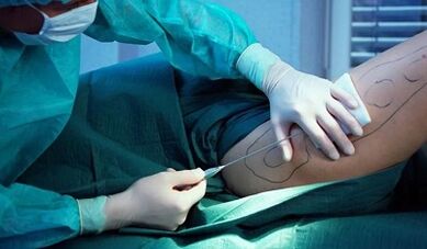 cirurgia para perda de peso